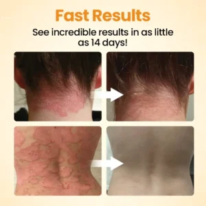 Timilk® BeeLieve Psoriasis Skin Care