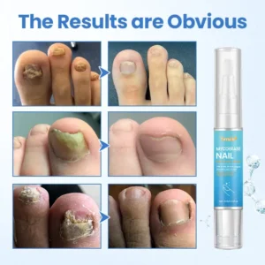 Timilk® MycoErase Nail Revive Pen