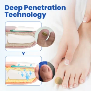 Timilk® FungalPatch - Antibacterial Fungal Patch⭐