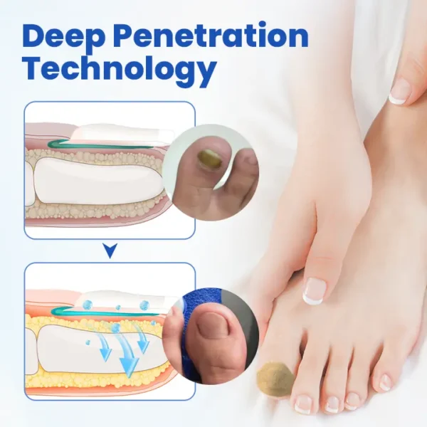 Timilk® FungalPatch - Antibacterial Fungal Patch⭐