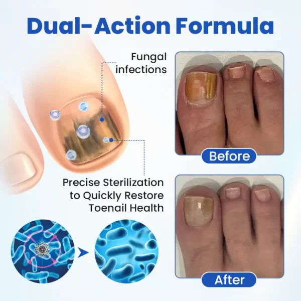 Timilk® FungalPatch - Antibacterial Fungal Patch⭐