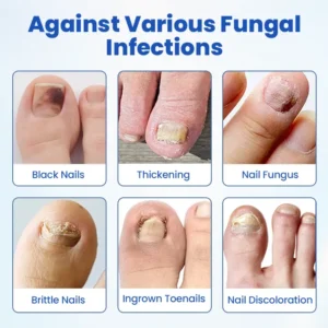 Timilk® FungalPatch - Antibacterial Fungal Patch⭐