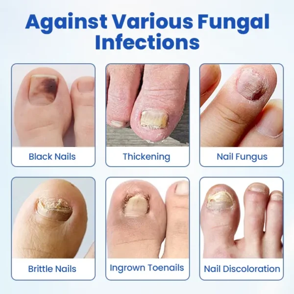 Timilk® FungalPatch - Antibacterial Fungal Patch⭐