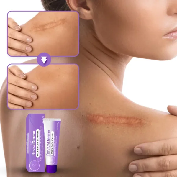 Timilk® RevivaDerma Face & Body Scar Gel - Clinically proven to soften, flatten and fade surgical scars, acne marks, burns, keloids and trauma-related scars
