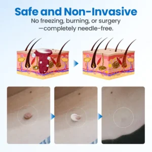 Timilk® TagGone Wart Removal Cream