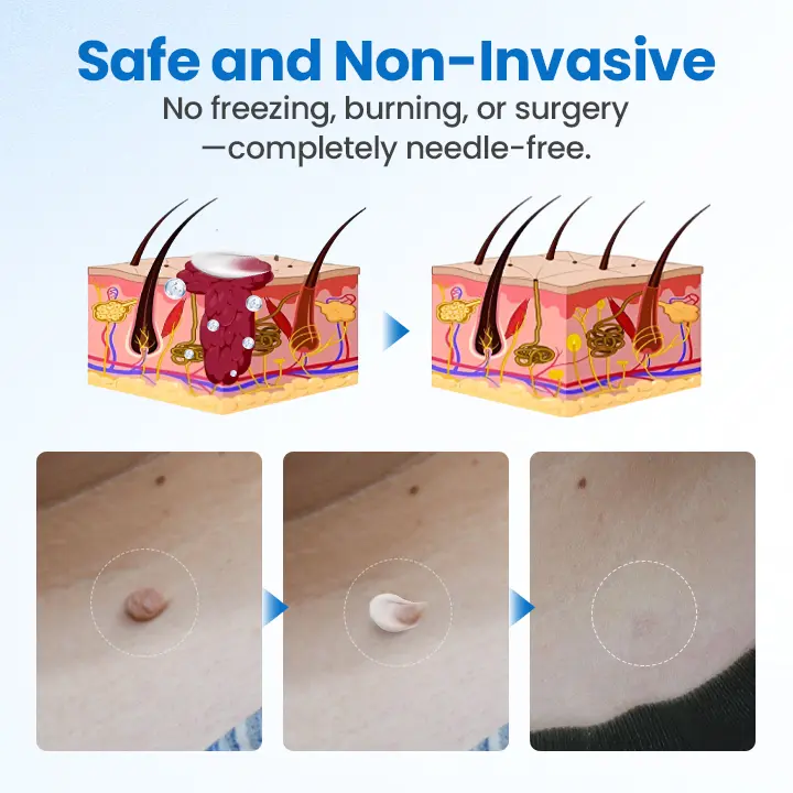 Timilk® TagGone Wart Removal Cream