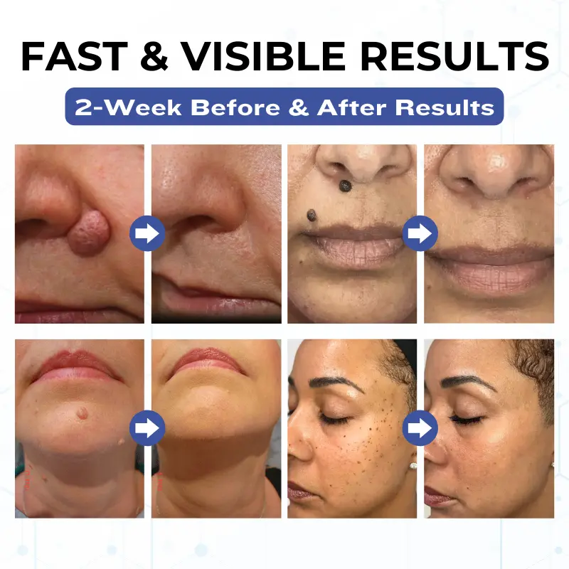 Timilk® VanishPro Skin Spot Removal Cream 🇬🇧 XH-VanishPro-upsell