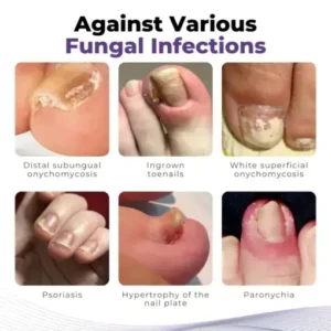 Timilk® MycoOut Natural Nail Fungus Solution