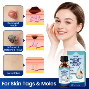 Timilk® WartLift Corn Removal Liquid (new)